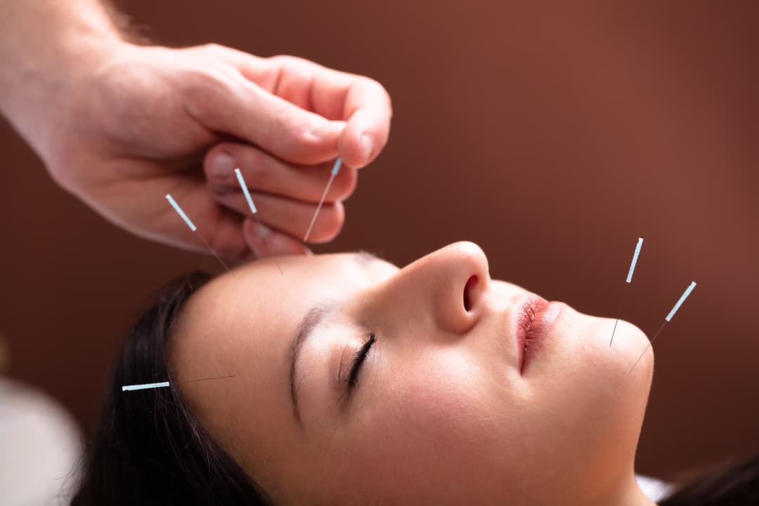 Acupuncture treatment
